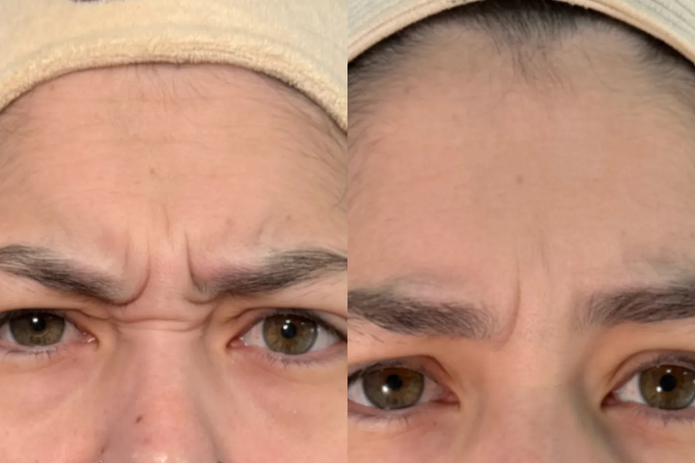 Antes e depois de aplicação de toxina na região da glabela