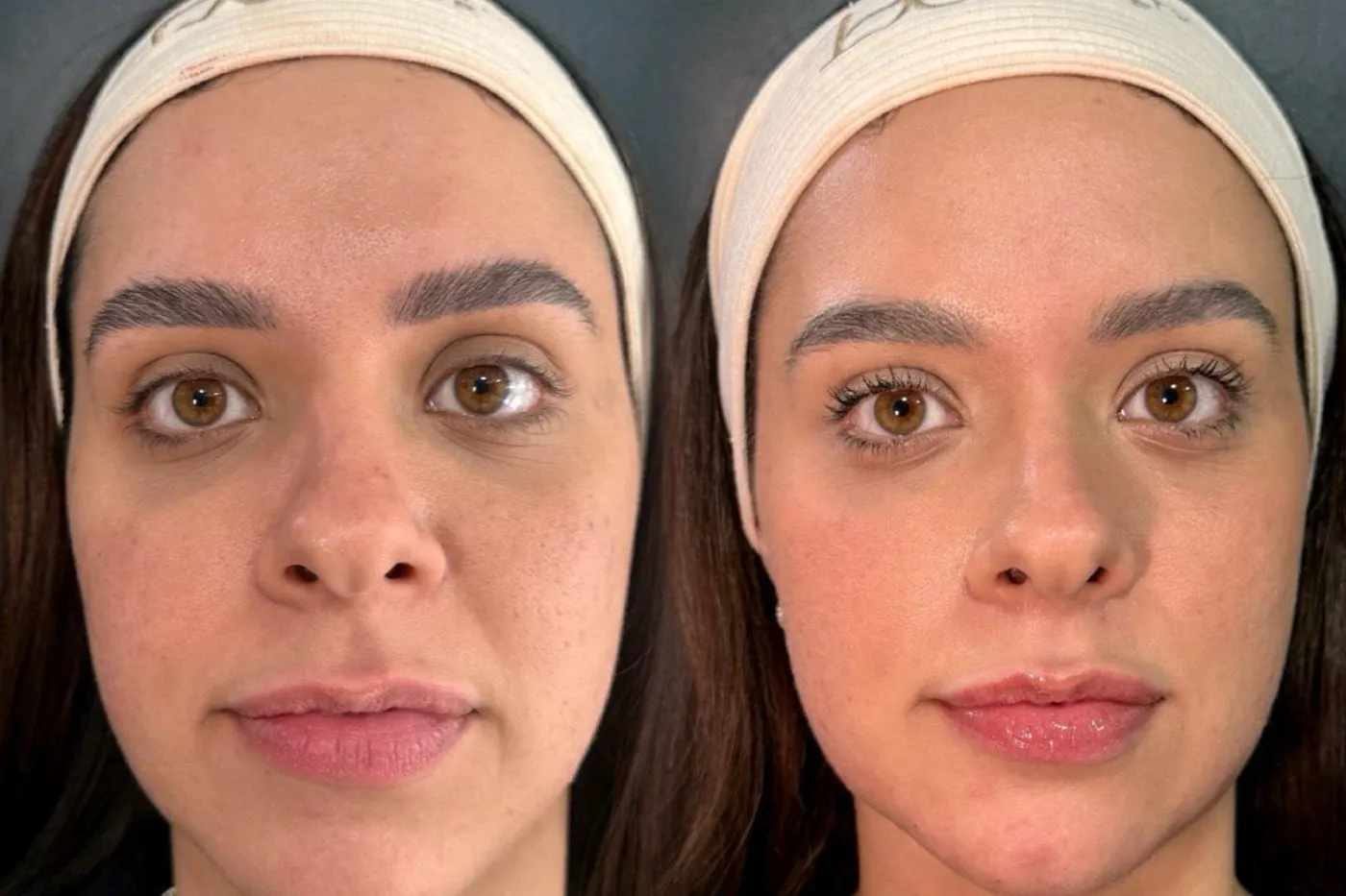 Antes e depois de uma harmonização facial realizada na clínica